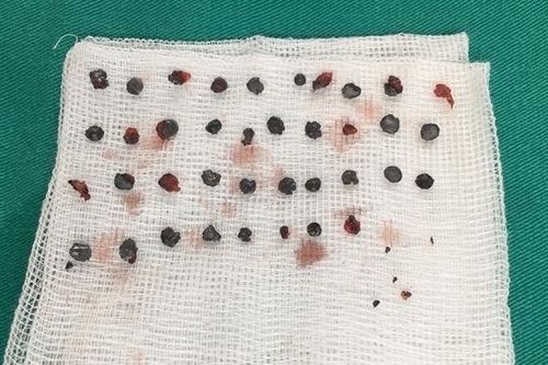 Nam thanh niên suýt mù do 50 viên đạn hoa cải găm trên mặt