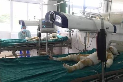 Tình trạng sức khỏe 3 trẻ mầm non bị bỏng khi học phòng chống cháy nổ