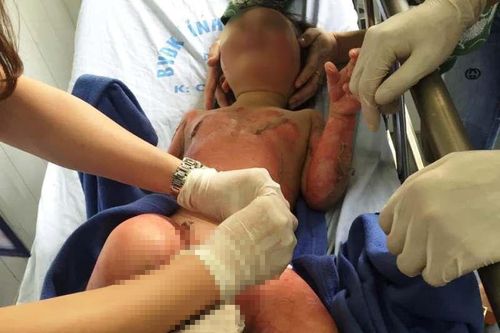 Hà Nam: 3 trẻ mầm non bỏng nặng khi học về kỹ năng cháy nổ