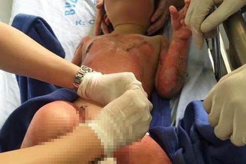3 trẻ mầm non bỏng nặng vì cô giáo đốt cồn dạy kỹ năng... phòng cháy