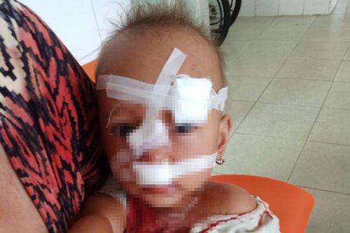 Bố mẹ cãi nhau, bé gái 2 tuổi nhập viện, khâu 12 mũi trên mặt