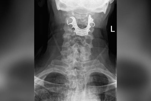 8 ngày sau phẫu thuật, cụ ông phát hiện bị kẹt hàm răng giả trong họng