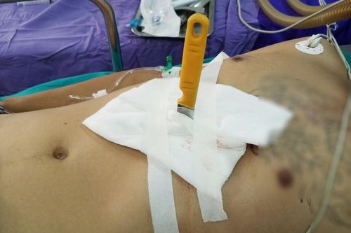 Cứu sống bệnh nhân bị hai nhát dao đâm thấu bụng