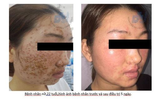 Dùng sữa rửa mặt quảng cáo online, bệnh nhân bị bội nhiễm da nặng