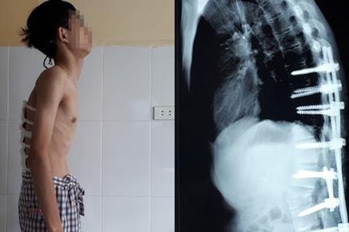 Giải thoát thanh niên 22 tuổi khỏi cảnh gù lưng như cụ ông