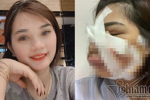 Cô gái xinh đẹp phải rạch mặt để nặn mủ sau tiêm mỡ tự thân làm đẹp