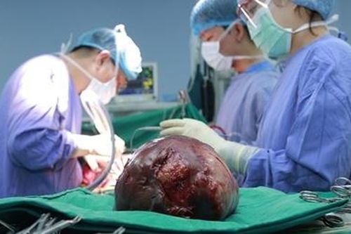 Suýt vỡ gan vì khối u khổng lồ