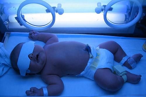 Chủ quan với bệnh vàng da có thể dẫn đến bại não ở trẻ sơ sinh