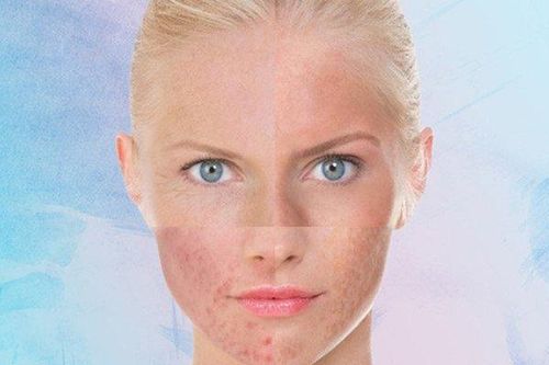 Phải làm thế nào khi làn da bị dị ứng mỹ phẩm?
