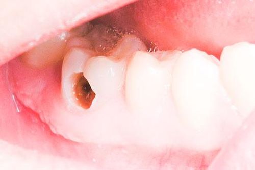 Dự phòng bệnh sâu răng ở trẻ em