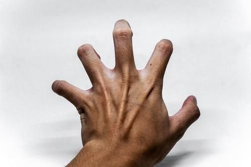 Người đàn ông lên cơn co giật 20 lần mỗi ngày vì sán làm tổ trong não