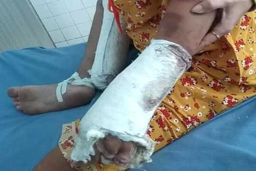 Bà bầu bị chồng hờ đánh gãy tay, chân