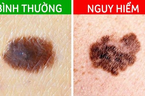 5 tín hiệu từ nốt ruồi cảnh báo ung thư đang tiềm ẩn dưới làn da