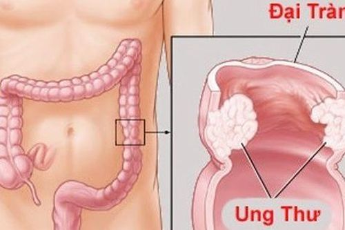 Bác sĩ cảnh báo: Bị đau bụng âm ỉ, có thể bạn đã bị ung thư nhưng không hề biết