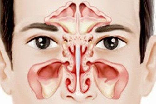 Người đàn ông mù mắt vì biến chứng viêm xoang ăn lan lên não
