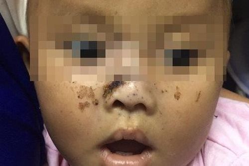 Bé trai 9 tháng tuổi bị 2 anh trai bắn súng vào mặt
