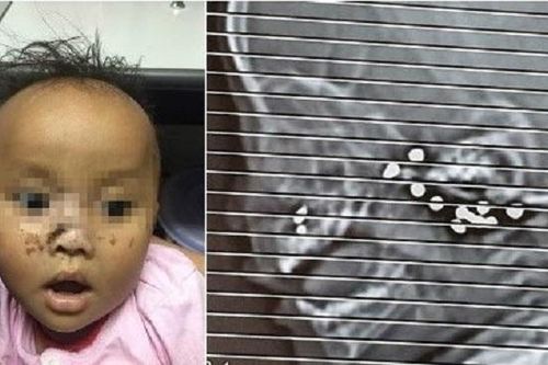 Cứu bé trai 9 tháng tuổi không may bị anh bắn 10 viên đạn chì vào mặt