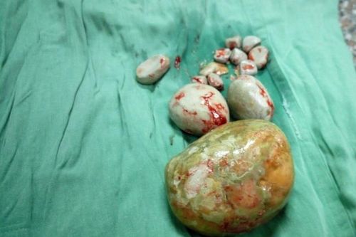 Kinh ngạc những ca phẫu thuật sỏi khổng lồ, BS cảnh báo nguyên nhân sỏi tiết niệu
