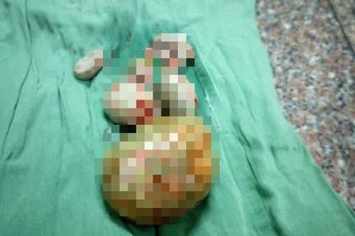 Lấy sỏi bàng quang 'khổng lồ' cho bà cụ 84 tuổi