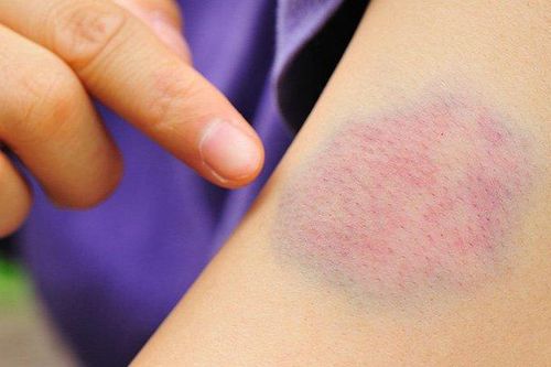 10 dấu hiệu ung thư sớm nhiều người thường chủ quan
