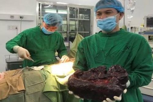 Cô gái mang khối u lá lách 'khủng' nặng 5kg, dài đến nửa mét