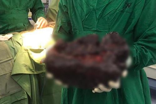 Căn bệnh khiến cô gái có lá lách khổng lồ, dài nửa mét và nặng hơn 5kg