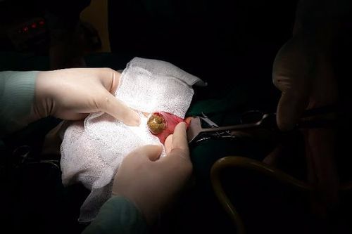 Ăn nhiều hồng ngâm, măng xào, cháu bé bị tắc ruột nguy hiểm