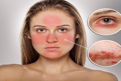 Mẹo chăm sóc da nhạy cảm nhất định phải biết