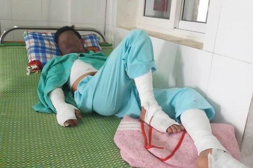 Điện thoại phát nổ khi đang sạc pin, nam thanh niên bị dập tay, bỏng nặng