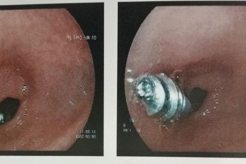 Phẫu thuật nội soi, lấy ốc vít từ da dày bé trai 18 tháng tuổi