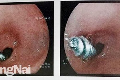 Nội soi lấy ốc vít dài 2,5cm cho bệnh nhi