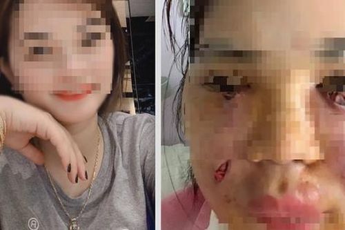 Hút mỡ làm đẹp: Tham một lần 'chơi lớn combo', gánh không nổi hậu họa