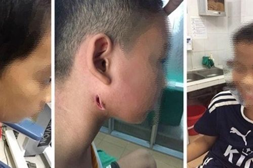 Nghệ An: Phát hiện 3 ca trẻ em nhiễm 'vi khuẩn ăn thịt người'