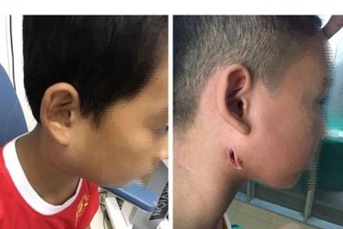 Phát hiện 3 trẻ mắc chứng bệnh vi khuẩn ăn mòn cơ thể