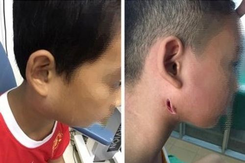 Nghệ An: Điều trị thành công cho một cháu bé nhiễm 'vi khuẩn ăn thịt người'