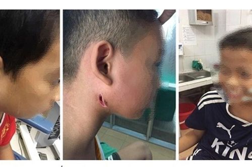 Biểu hiện và cách phòng bệnh whitmore