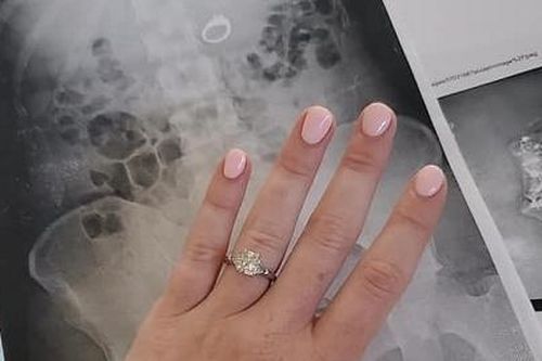 Lo bị mất cắp, cô dâu nuốt nhẫn kim cương khi ngủ mơ