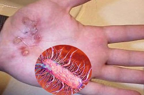 Bác thông tin 'vi khuẩn ăn thịt người' xuất hiện tại Quảng Bình