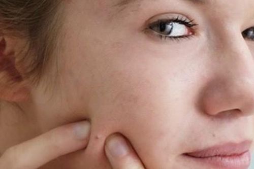 Nhiễm trùng huyết vì nặn mụn, việc nhỏ nhưng lại gây họa lớn