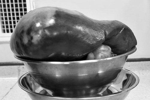 Bệnh nhân có khối u lách nặng 2,3kg