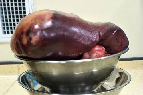Cắt khối u lách khổng lồ nặng 2,3 kg