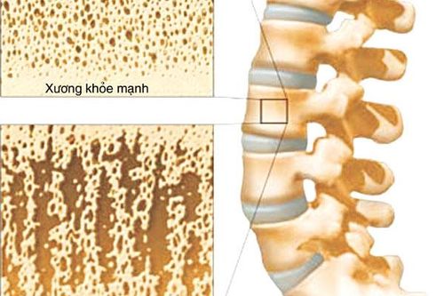 Loãng xương - căn bệnh nguy hiểm với người cao tuổi