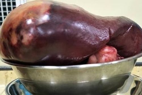 Phẫu thuật lấy khối u lách khổng lồ cho bệnh nhân 24 tuổi.