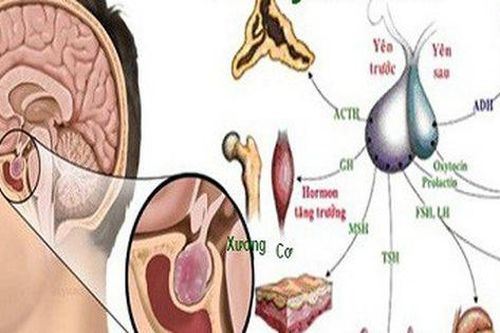 Dấu hiệu bị u tuyến yên, nhiều người có mà không biết
