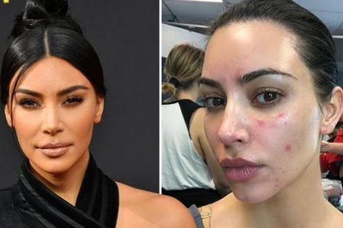 Kim Kardashian đăng ảnh mặt mộc bị vảy nến