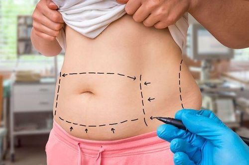 Đốt cháy quá trình giảm cân bằng hút mỡ có thật sự 'thần thánh' như lời đồn