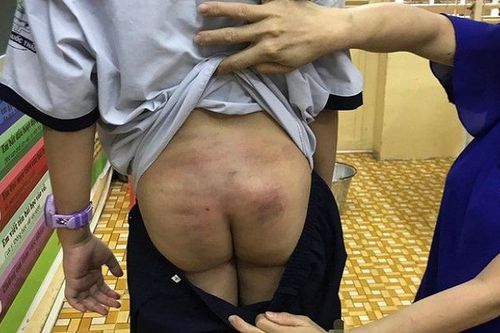 Nghi vấn bé trai 11 tuổi bị bạo hành trong thời gian dài khi ở cùng bố và mẹ kế tại Sài Gòn