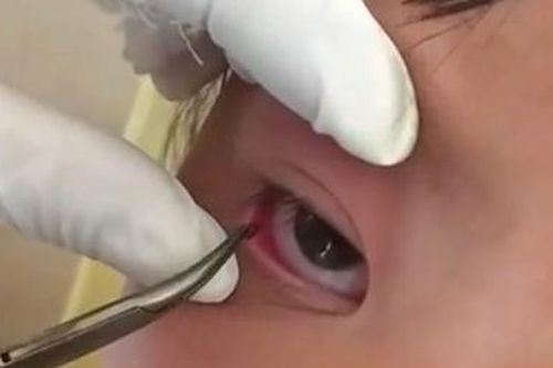 Phẫu thuật lấy con vắt từ mắt bé gái