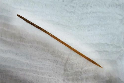 Người đàn ông ngủ quên, nuốt tăm tre dài 6 cm vào bụng