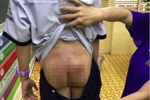 Bé 10 tuổi bị bố, mẹ kế bạo hành: Mẹ được quyền nuôi, sao 'ủn' cho bố?